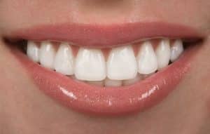 Dental Veneers in Anchorage, AK