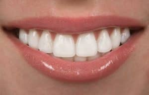 Porcelain Veneers