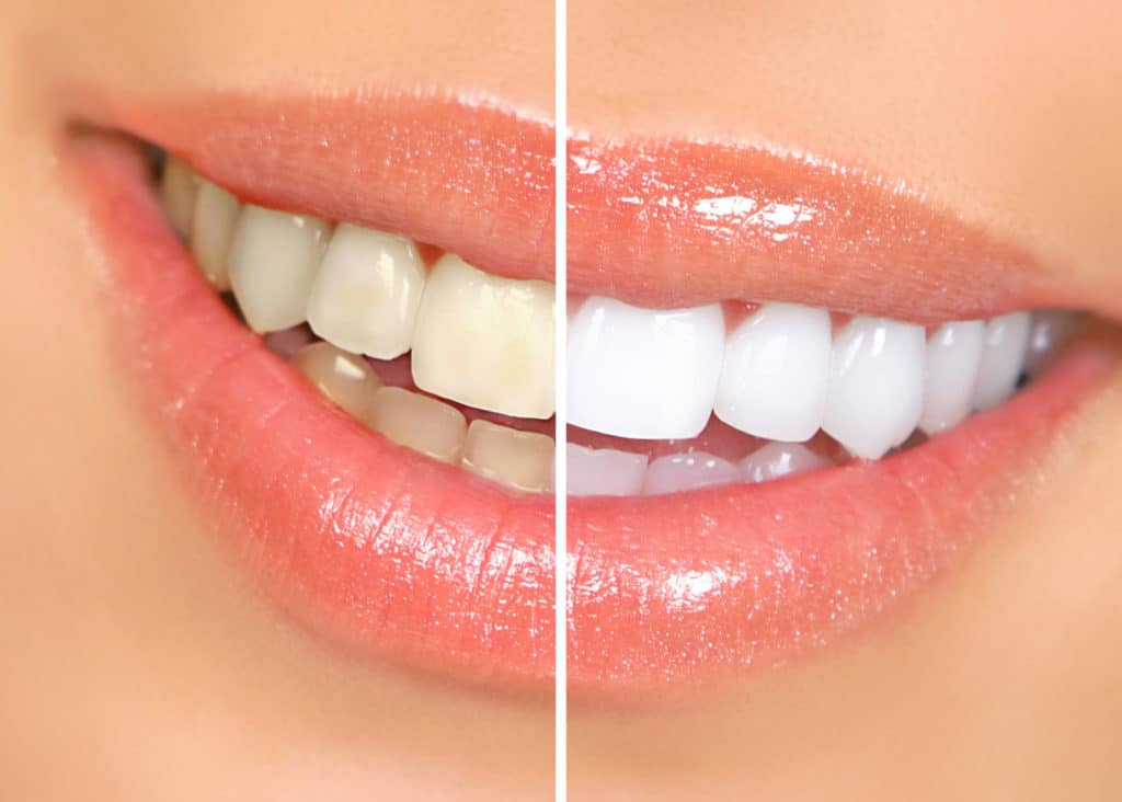 In-Office Teeth Whitening Benefits